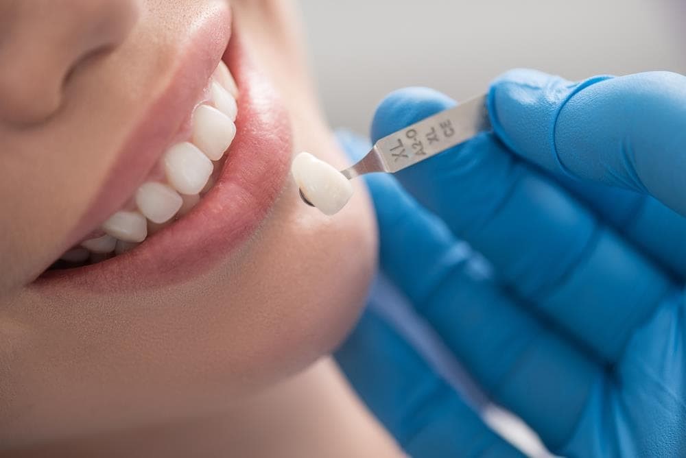 ¿En cuántas sesiones se coloca un implante dental?