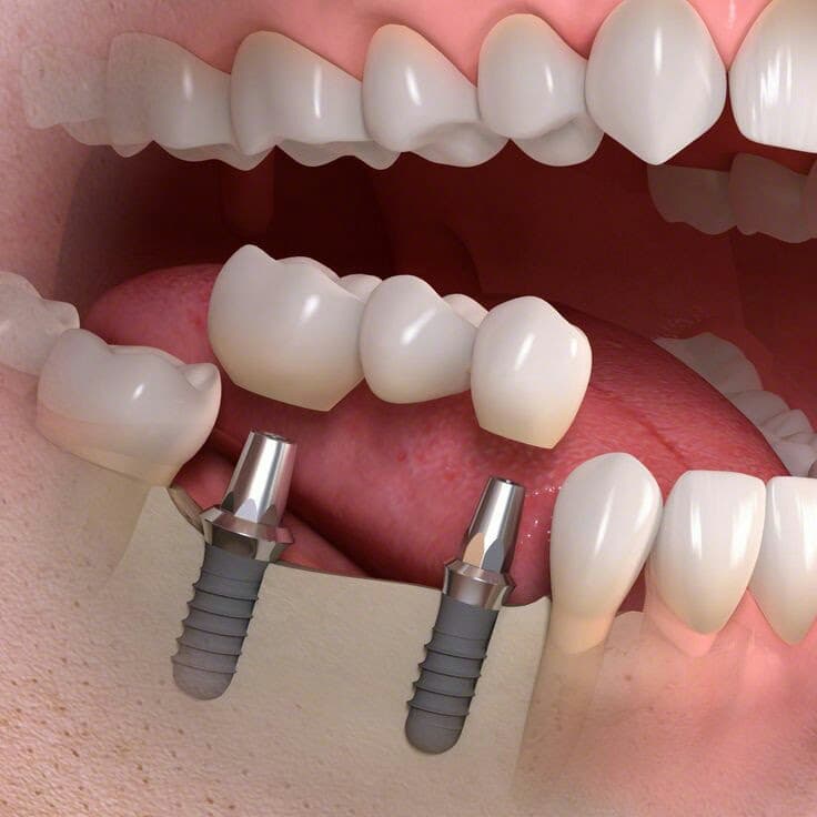 Ponte en manos de un implantólogo para mejorar tu dentadura