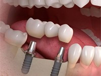 ¿Los implantes dentales son para toda la vida?